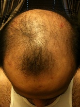 scalp psor after 2 wks